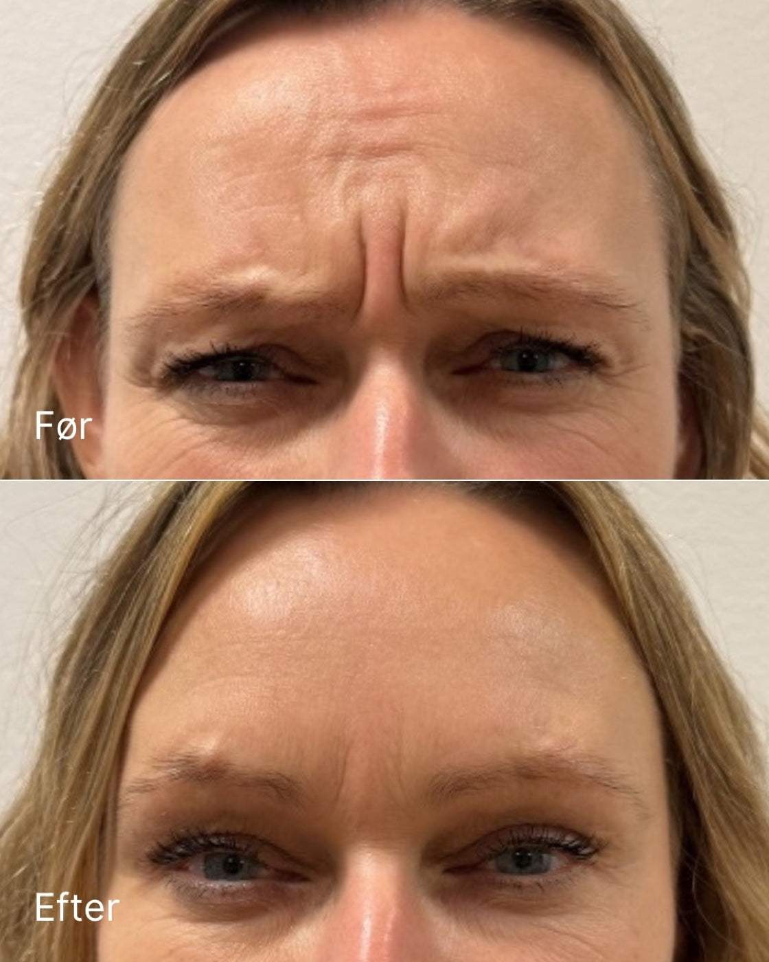 Botox