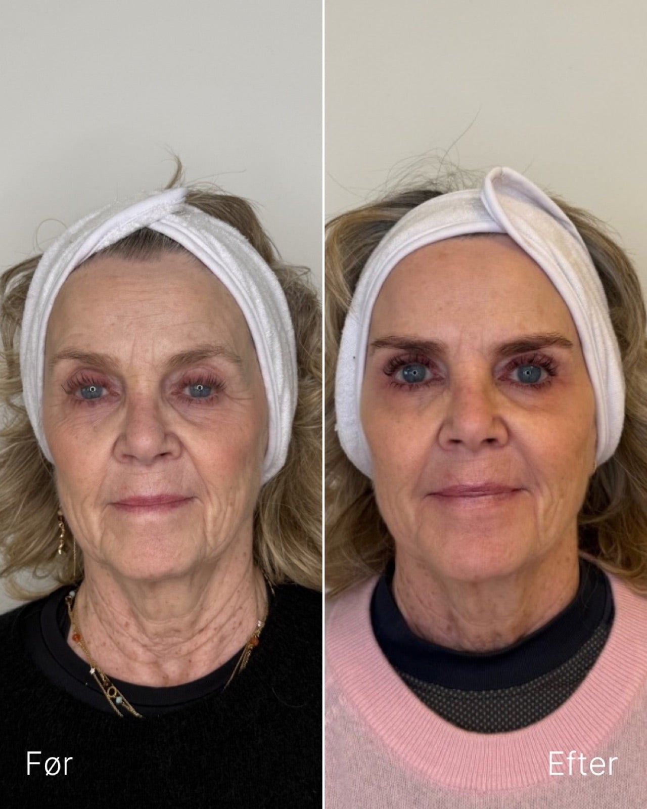 Skinbooster