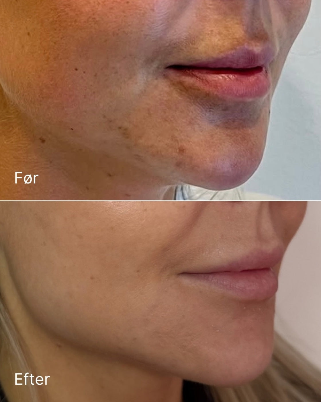 I-PRF & Microneedling