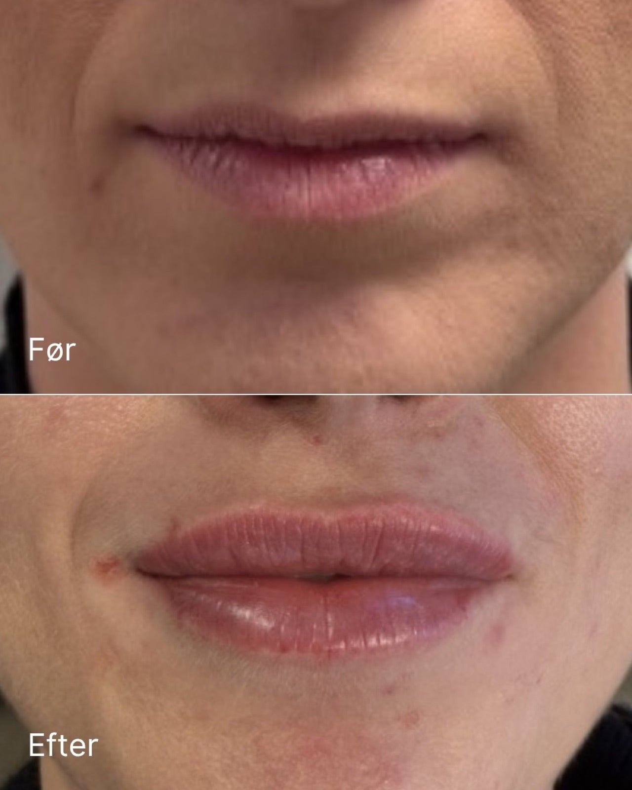 Filler – før / efter