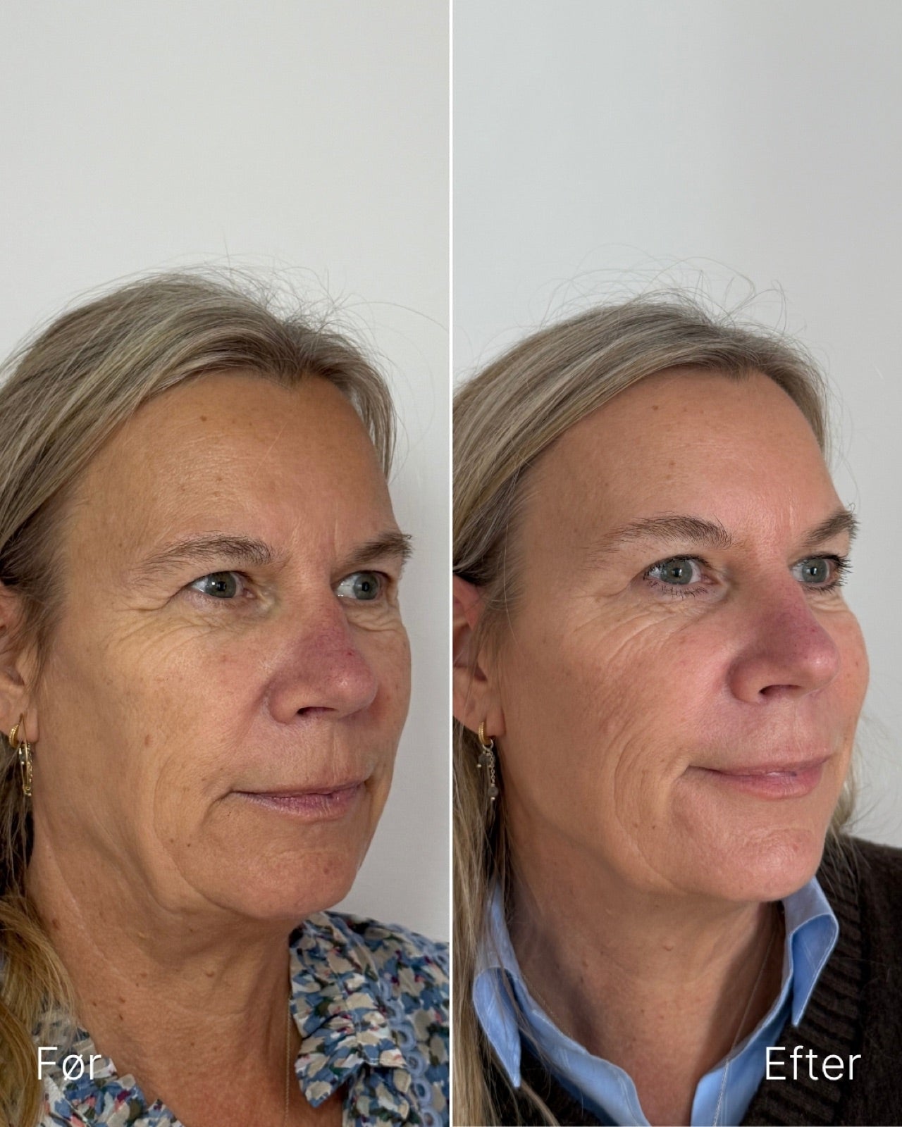 Skinbooster – før / efter